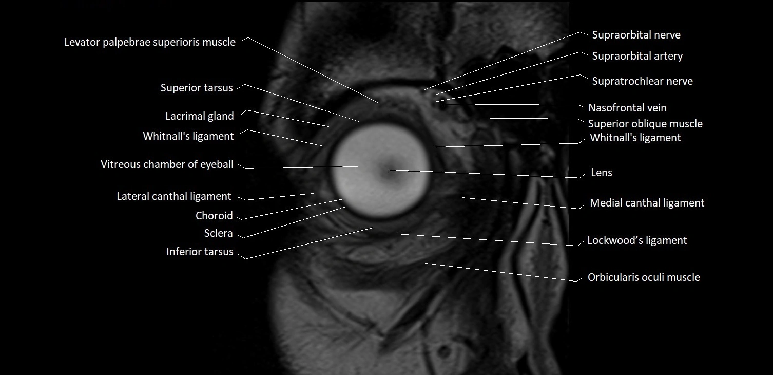 MRI Orbit coronal cross sectional anatomy image 3.webp